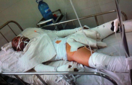 Đi bắt bệnh nhân tâm thần, điều dưỡng viên bị "thiêu sống" - 2 Điều dưỡng Đấu đang được điều trị tích cực tại bệnh viện Chợ Rẫy