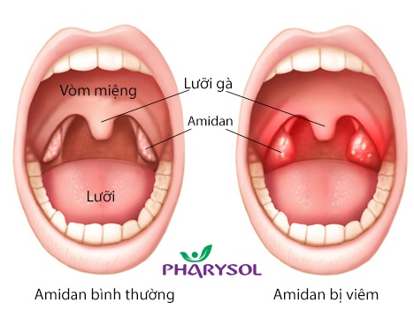 Viêm Amidan có thể chữa khỏi mà không cần cắt bỏ - 2 Viêm Amidan có thể chữa khỏi mà không cần cắt bỏ - 2