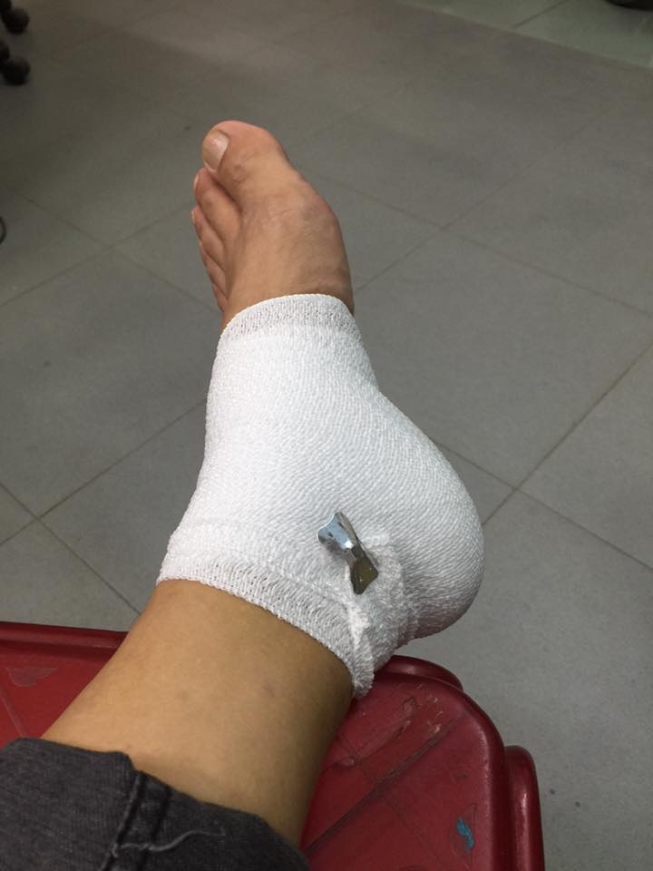 NSƯT Thành Lộc phải nhập viện vì chấn thương trên phim trường - 4 Thành Lộc đã phải vào bệnh viện bó bột ngay sau đó. Ảnh: ĐLP.