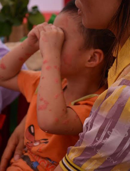 Chữa khỏi vẩy nến hoàn toàn: Chỉ là đồn thổi! - 1 Những tổn thương trên da của bệnh nhân vẩy nến. Ảnh: P.L