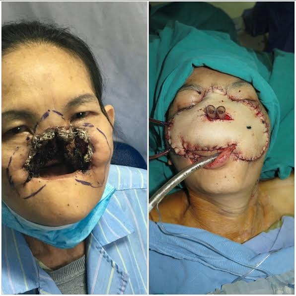 Hình ảnh bệnh nhân trước và sau phẫu thuật.