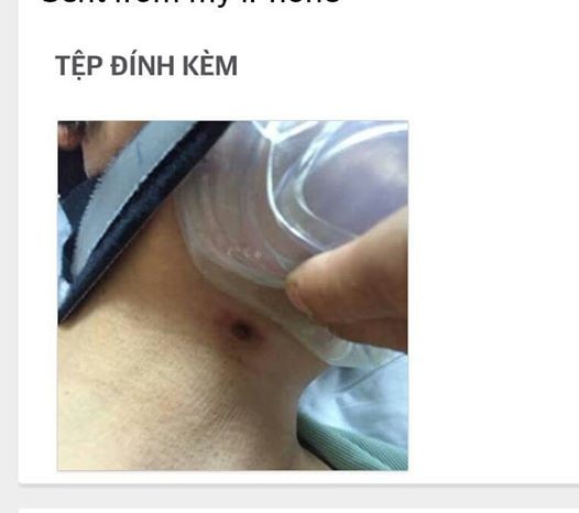 Hội chẩn qua mạng xã hội, cứu bé sơ sinh 10 giờ tuổi nguy kịch - 2 Hình ảnh hội chẩn được gửi qua Zalo tới BS BV Bệnh Nhiệt đới Trung ương.