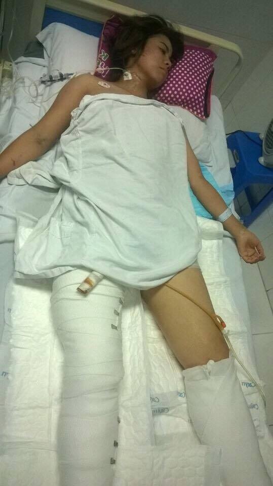 Và hiện tại vẫn phải lọc máu do suy thận, thay băng chân thường xuyên nhưng tiên lượng giữ chân khó khăn vì chấn thương nặng.