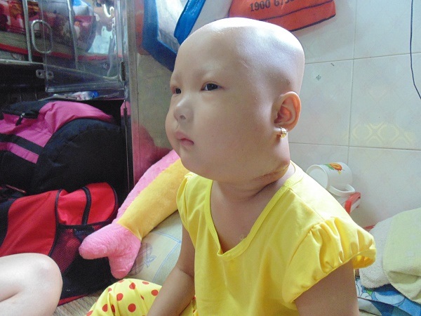 Sự sống mong manh của bé gái 5 tuổi mắc chứng ung thư hạch - 2 Tuyết vốn là một cô bé hoạt bát, nhưng căn bệnh quái ác biến con thành cô bé u buồn, khó tính