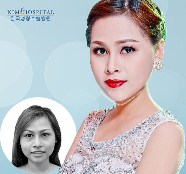 Phẫu thuật gọt mặt V line: Những biến chứng cần biết - 4 Người mẫu ảnh Emily Linh đẹp hơn, thành công hơn sau khi gọt mặt V line, nâng mũi S line tại bệnh viện thẩm