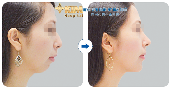 Độn cằm có tạo được mặt V line hay không? - 2 Khách hàng có khuyết điểm cằm bị ngắn, lẹm bị khắc phục nhanh chóng, không để lại sẹo sau khi độn cằm V line tại bệnh viện KIM