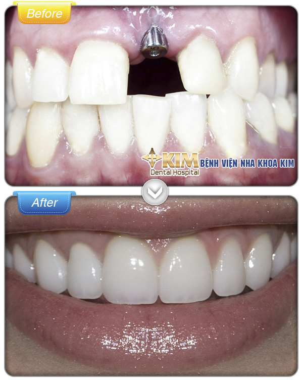 Thực hiện trồng răng tại KIM Dental Hospital - bệnh viện nha khoa đầu tiên tại Việt Nam, răng được phục hình nhanh chóng, an toàn, không đau, đảm bảo chức năng ăn nhai, đồng thời tính thẩm mỹ vượt trội hơn cả