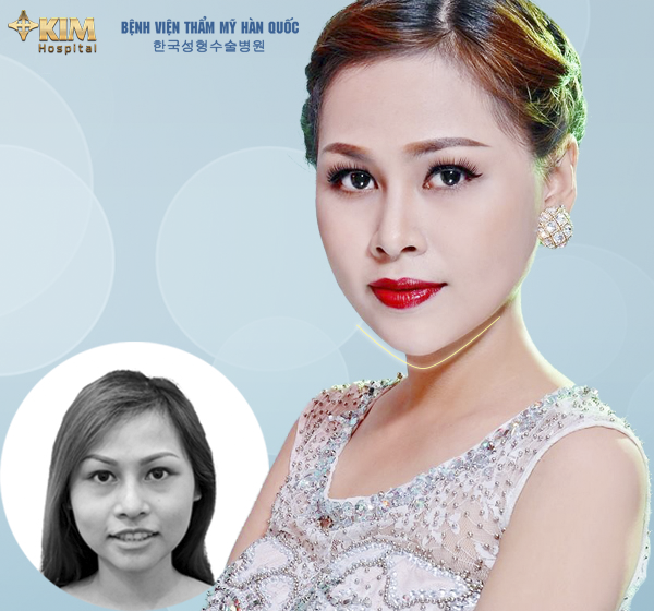 Nâng tầm nhan sắc nhờ gọt mặt V line - 4 Người mẫu ảnh Emily Linh đẹp hơn, thành công hơn sau khi gọt mặt V line, nâng mũi S line tại KIM Hospital do trực tiếp bác sĩ Nam thực hiện