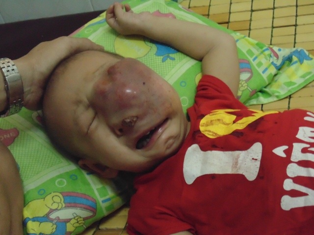 Nỗi lo lớn nhất của gia đình cũng như y bác sĩ tại bệnh viện Ung bướu TPHCM là bé không đáp ứng thuốc, khối u ngày một to dần mà không thể phẫu thuật vì thể trang bé quá yếu