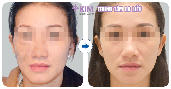 Sau khi điều trị nám, tàn nhang tại KIM Skin do trực tiếp bác sĩ nội trú da liễu Trình Ngô Bỉnh thực hiện, khách hàng đã lấy lại được làn da sáng mịn như trước đây.