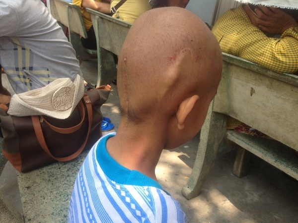 Bé Trí Tâm được mổ để gắn ống dịch não tủy để hút dịch tủy ra khỏi não