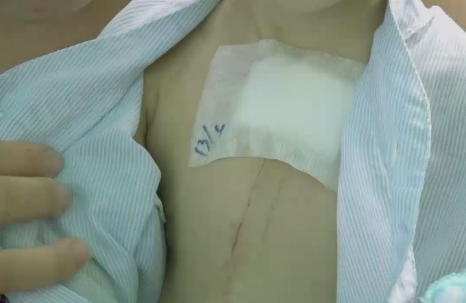 Vết mổ đã lành và sức khỏe bé đã ổn định