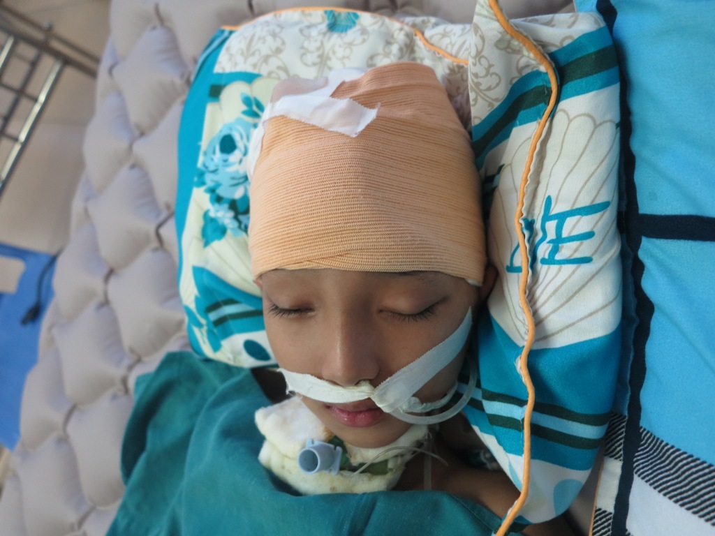 Bị đánh quá mạnh khiến phần xương sọ phía bên trái của cháu Chiến bị vỡ, khi cháu hồi phục sẽ tiến hành phẫu thuật cấy ghép nhưng chi phí rất cao.