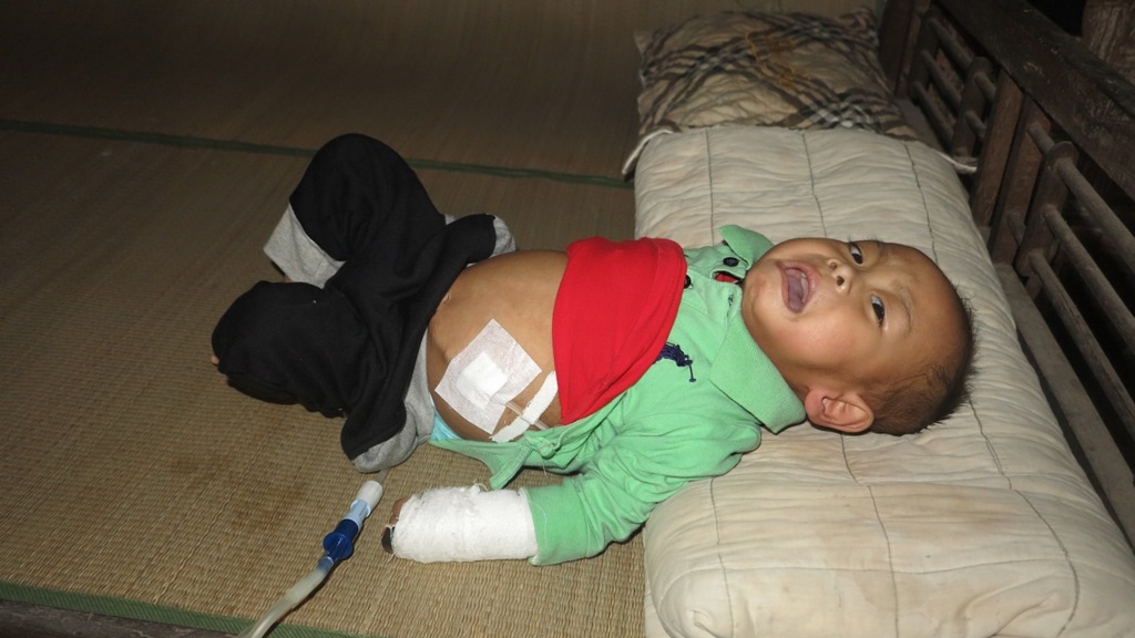 Đã 2 năm nay sự sống của Gia Huy được duy trì bằng máy móc, hiện sức khỏe của em rất yếu, nếu không được ghép thận có thể tính mạng em sẽ rất nguy hiểm.