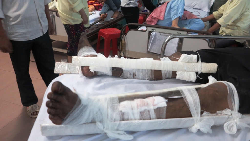 
Nạn nhân bị gỗ văng đè gãy chân.
