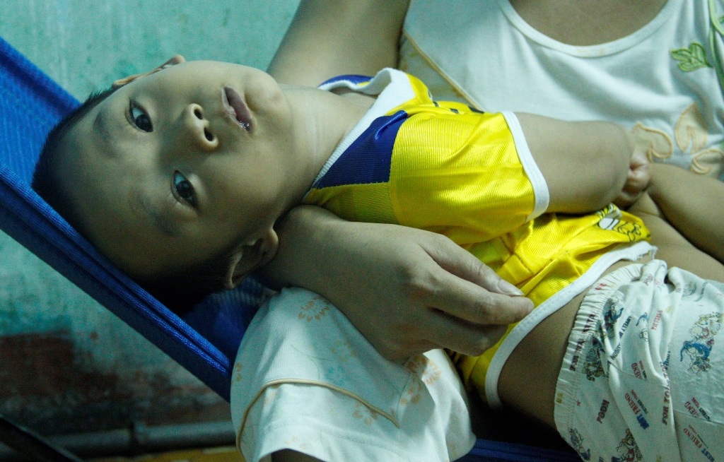 Cháu Hoàng khỏe mạnh bình thường chỉ một trận sốt nhẹ trở thành đứa trẻ nằm một chỗ, không nói được...