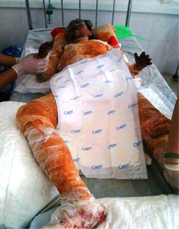 Túi nilon đựng xăng bốc cháy sau va chạm, một người tử vong - 3
Thành người bị thiêu cháy biến dạng, tay bị hoại tử