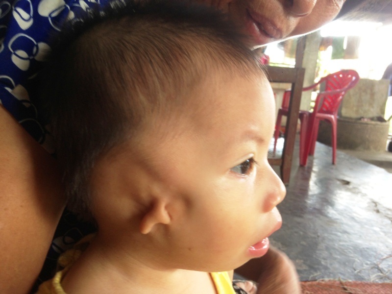 Thương bé 19 tháng tuổi không có vành tai, hở hàm ếch - 1 Thương bé 19 tháng tuổi không có vành tai, hở hàm ếch - 1