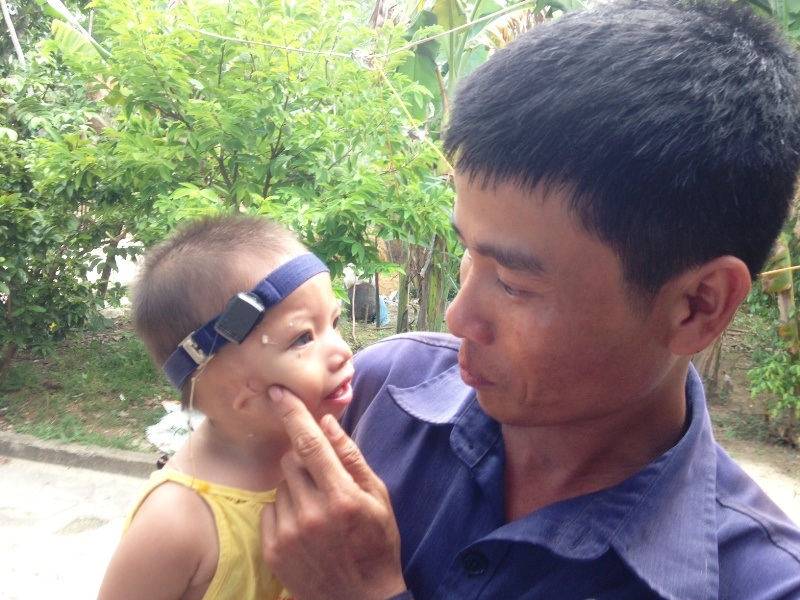 Thương bé 19 tháng tuổi không có vành tai, hở hàm ếch - 7 Bé Thanh Tấm và gia đình đang cầu mong sự giúp đỡ của cả cộng đồng để bé có thể sớm lành lặn như bao đứa trẻ bình thường khác