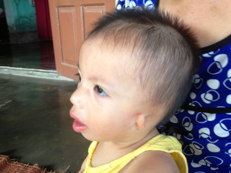 Thương bé 19 tháng tuổi không có vành tai, hở hàm ếch - 2 Vừa lọt lòng mẹ, bé Thanh Tấm đã mang trên mình đa dị tật, hở hàm ếch, không có vành tai hai bên