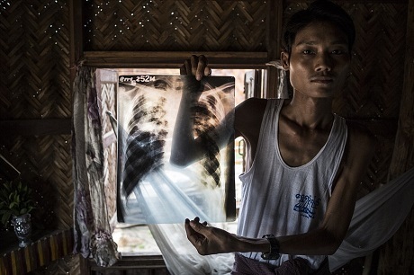 Anh Ko Maw Gyi, một cựu thợ mỏ, đang cầm trong tay tấm phim chụp phổi, cho thấy lá phổi của anh đã bị tàn phá thế nào sau hai năm làm việc trong những khu khai mỏ ở Mandalay, Myanmar. Ảnh của Andre Malerba.