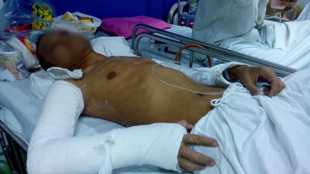 Hà Nội: Đang ngồi uống nước ở vỉa hè, bị nhóm côn đồ xông vào đánh trọng thương - 1 Anh Đại đang điều trị tại Bệnh viện Việt Đức.