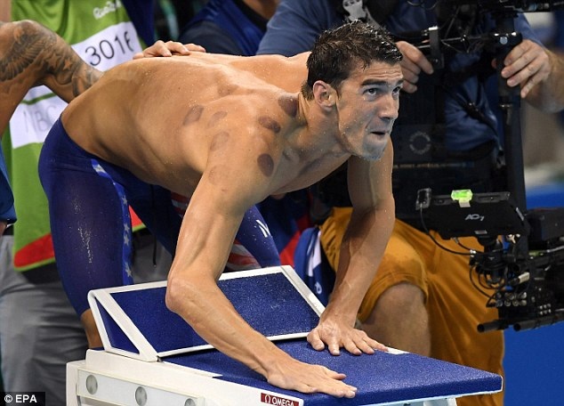 Michael Phelps và nhiều VĐV Mỹ “nghiện”… giác hơi - 1 Michael Phelps lộ vết bầm tím do giác hơi