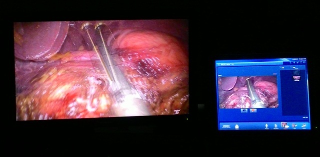Mổ nội soi ung thư dạ dày bằng kỹ thuật 3D đầu tiên Việt Nam - 4 Hình ảnh trên màn hình 3D (phải đeo kính vào thì mới thấy rõ chi tiết)