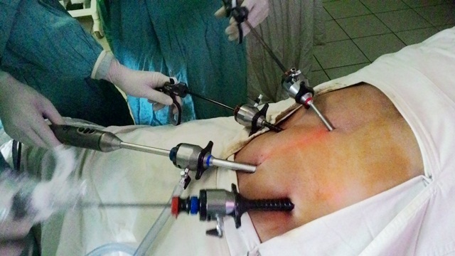 Mổ nội soi ung thư dạ dày bằng kỹ thuật 3D đầu tiên Việt Nam - 3 Có đến 4 đường dẫn vào bụng bệnh nhân để đưa camera và các dụng cụ mổ nội soi 3D