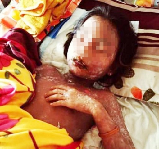 Em K.A. bị dị ứng da phồng rộp như bỏng (ảnh: Tuổi trẻ)