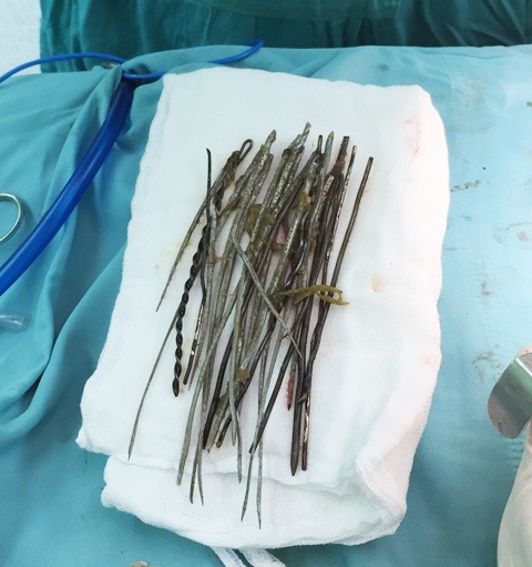 30 thanh sắt kích cỡ từ 7-8 cm/thanh đã được lấy ra toàn bộ. Bệnh nhân này trong cơn ngáo đã nuốt hết bó sắt này (ảnh: Bệnh viện Trung ương Huế cung cấp)