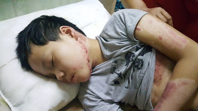Cháu bé nướng khoai bị bỏng nặng đã được xuất viện về nhà - 3
Một phần mặt trái của em thì lành lặn và đẹp hơn khi mới vào viện