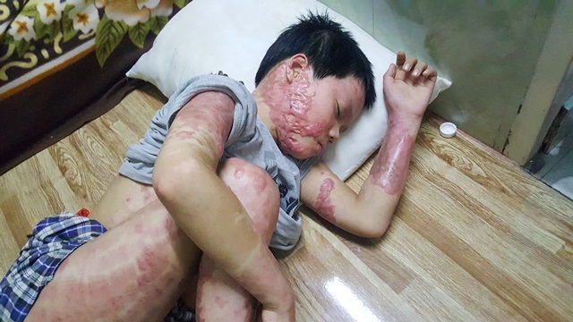 Cháu bé nướng khoai bị bỏng nặng đã được xuất viện về nhà - 2 Một phần mặt bên phải của Sơn có sẹo lồi, nhưng qua thời gian vết sẹo sẽ đỡ hơn