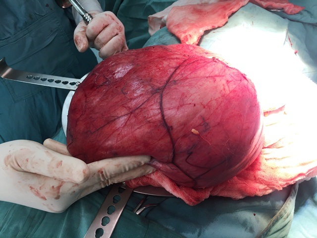 Mục sở thị khối u mỡ nặng tới 6kg trong ổ bụng - 3 Khối u đã được bóc tách thành công ra khỏi bụng bệnh nhân