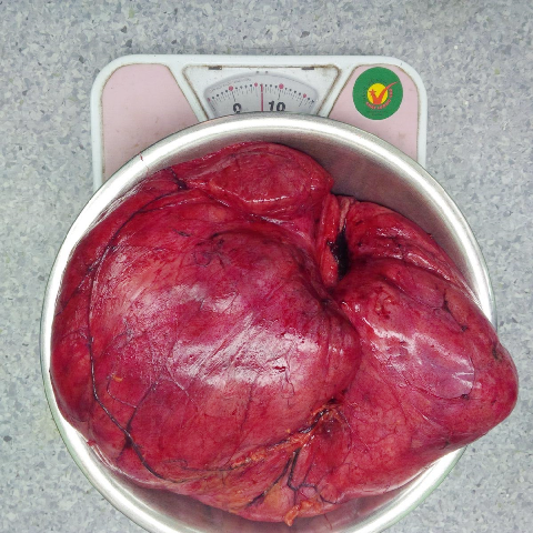 Mục sở thị khối u mỡ nặng tới 6kg trong ổ bụng - 5 Trọng lượng khủng hơn 6kg của khối u trong bụng chị H. được các bác sĩ Trung tâm Điều trị theo yêu cầu & Quốc tế, Bệnh viện Trung ương Huế phẫu thuật lấy ra thành công
