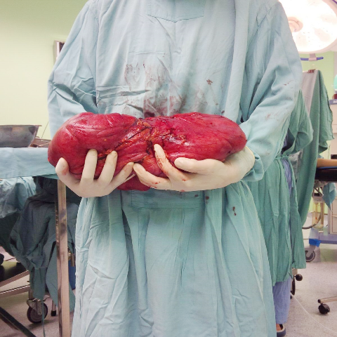Mục sở thị khối u mỡ nặng tới 6kg trong ổ bụng - 4 Nhìn khối u còn lớn hơn cả một em bé sơ sinh