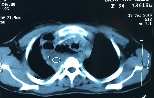Cứu sống 1 bệnh nhân bị áp xe trung thất do thủng thực quản - 1 Hình ảnh áp xe trung thất trên CT Scan