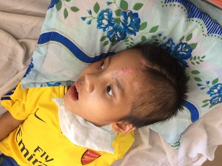 
Hiện tại hộp sọ của em Nghĩa đang gửi nuôi ở một bệnh viện tại TPHCM nhưng gia đình chưa có tiền để phẫu thuật ghép sọ cho em
