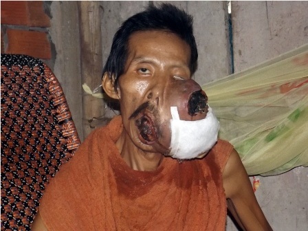 Người đàn ông bị khối u chiếm hết khuôn mặt không tiền điều trị - 1
Khối u ác tính chiếm hết khuôn mặt của anh Ân