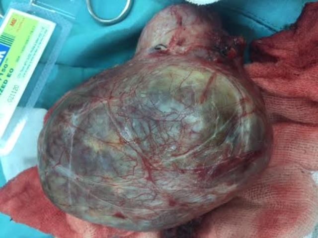 Cắt khối bướu cổ nặng 1kg chèn ép khí quản - 2 Khối u sau khi được bóc tách ra khỏi cổ bệnh nhân
