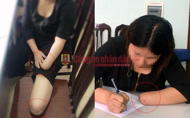 Vụ thuê người chặt chân, tay: Cảnh sát kể chuyện lần tìm manh mối - 2 Chân trái và tay trái chị N. bị cắt cụt. (Ảnh: Công an nhân dân)