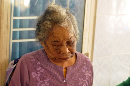 
Khắp mặt người mẹ già bầm tím do đứa con nghịch tử gây nên
