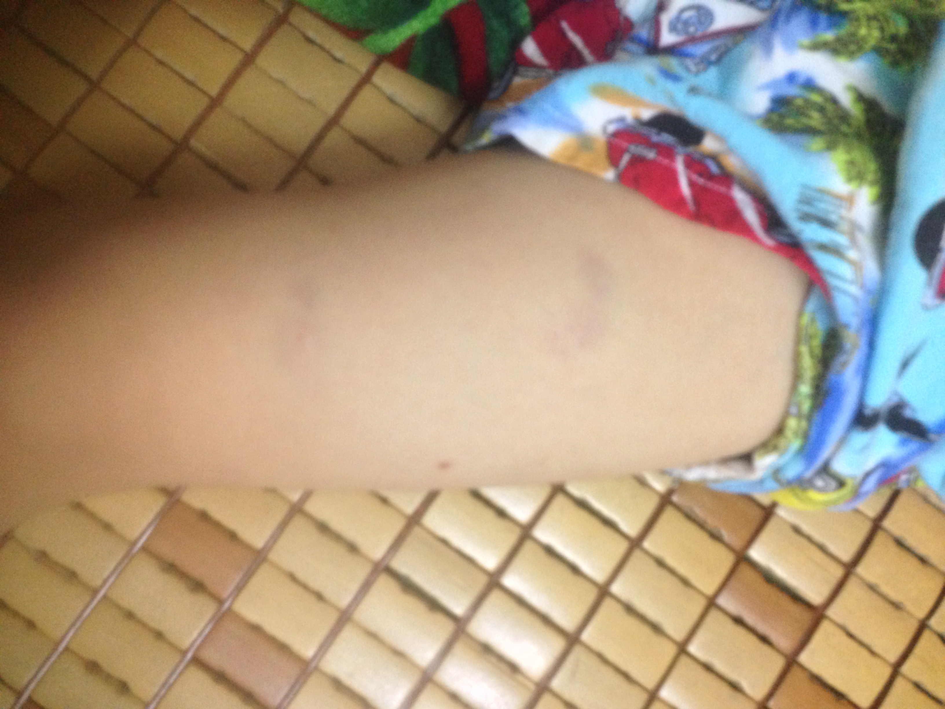 Hai vết thâm tím ở đùi cháu bé sau buổi học chiều 15/6