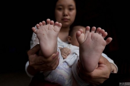 Bé trai có 15 ngón tay và 16 ngón chân - 2 ... và 16 ngón chân trên cơ thể của mình