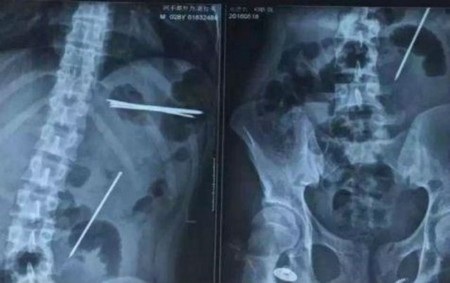 Phim chụp X-quang cho thấy những cây đinh nằm rải rác trong cơ thể của bệnh nhân