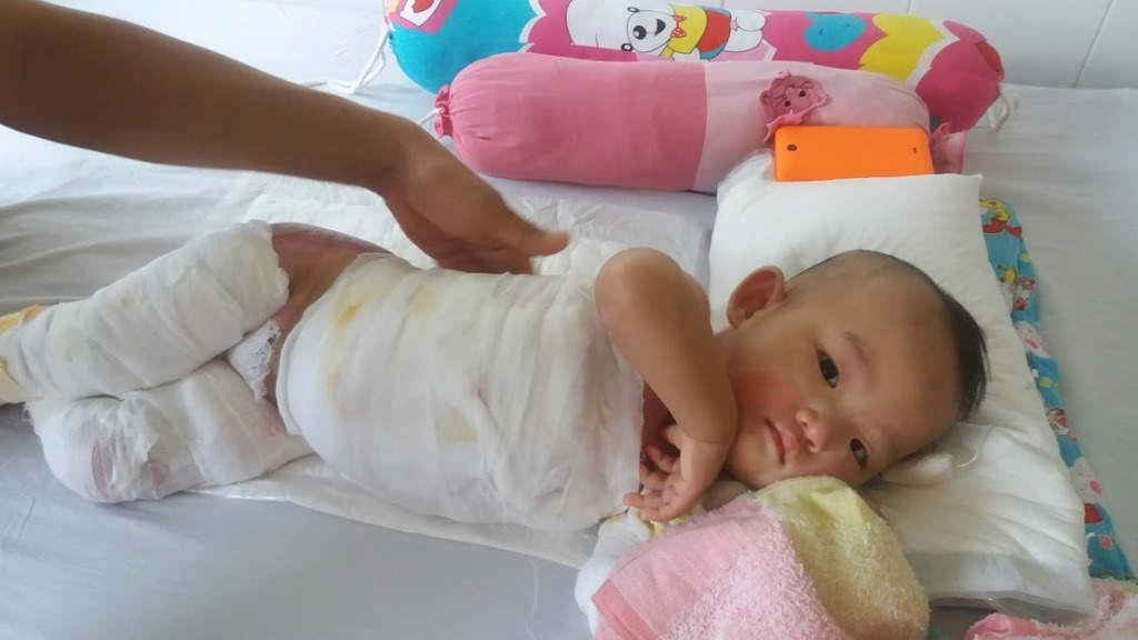 Thương cháu bé 11 tháng tuổi bị bỏng nước sôi nặng - 1 Bé Hoàng Thư bị bỏng 70% cơ thể đang được điều trị tại Bệnh viện Phụ sản - Nhi Đà Nẵng