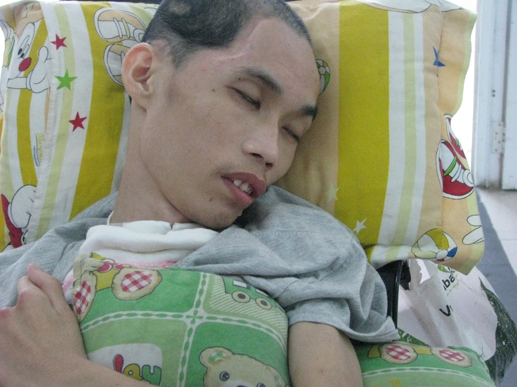 
Một bên đầu bị móp do bị đánh
