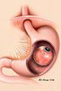 Chữa béo phì bằng cách hút thức ăn khỏi... dạ dày - 2