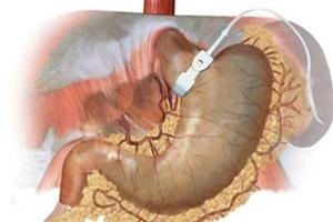 Chữa béo phì bằng cách hút thức ăn khỏi... dạ dày - 3