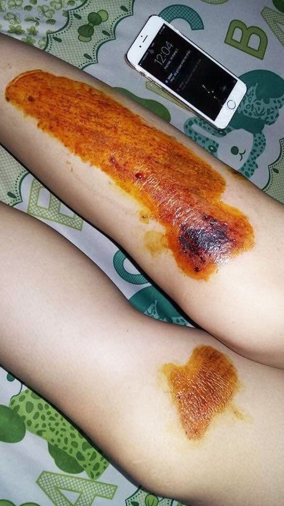 Vết thương trên chân của ca sĩ Tố Ny sau khi bị cướp kéo lê trên đường